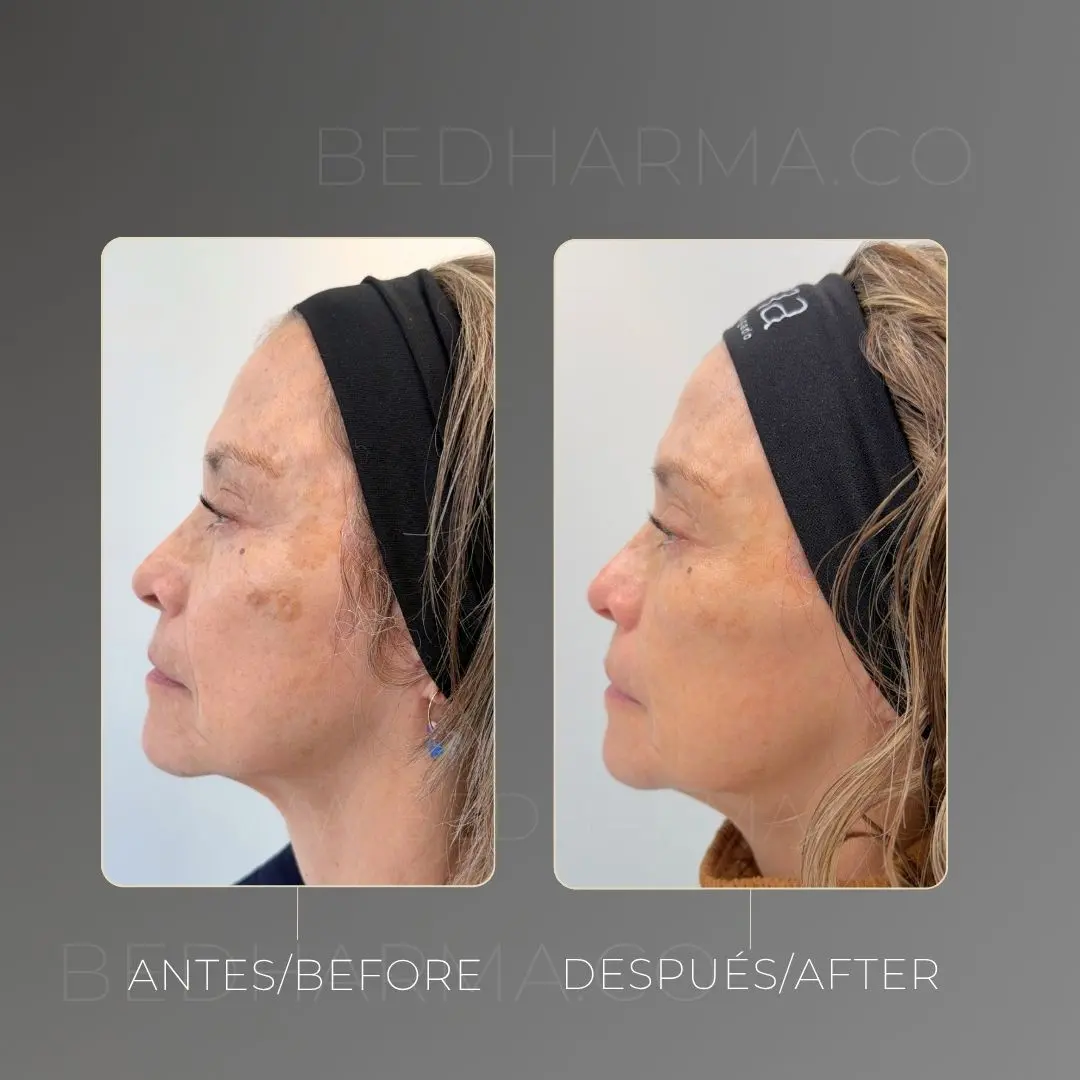 Despigmentación de melasma con láser colormax antes y después en Medellín - Clínica Estética Be Dharma 020826 1