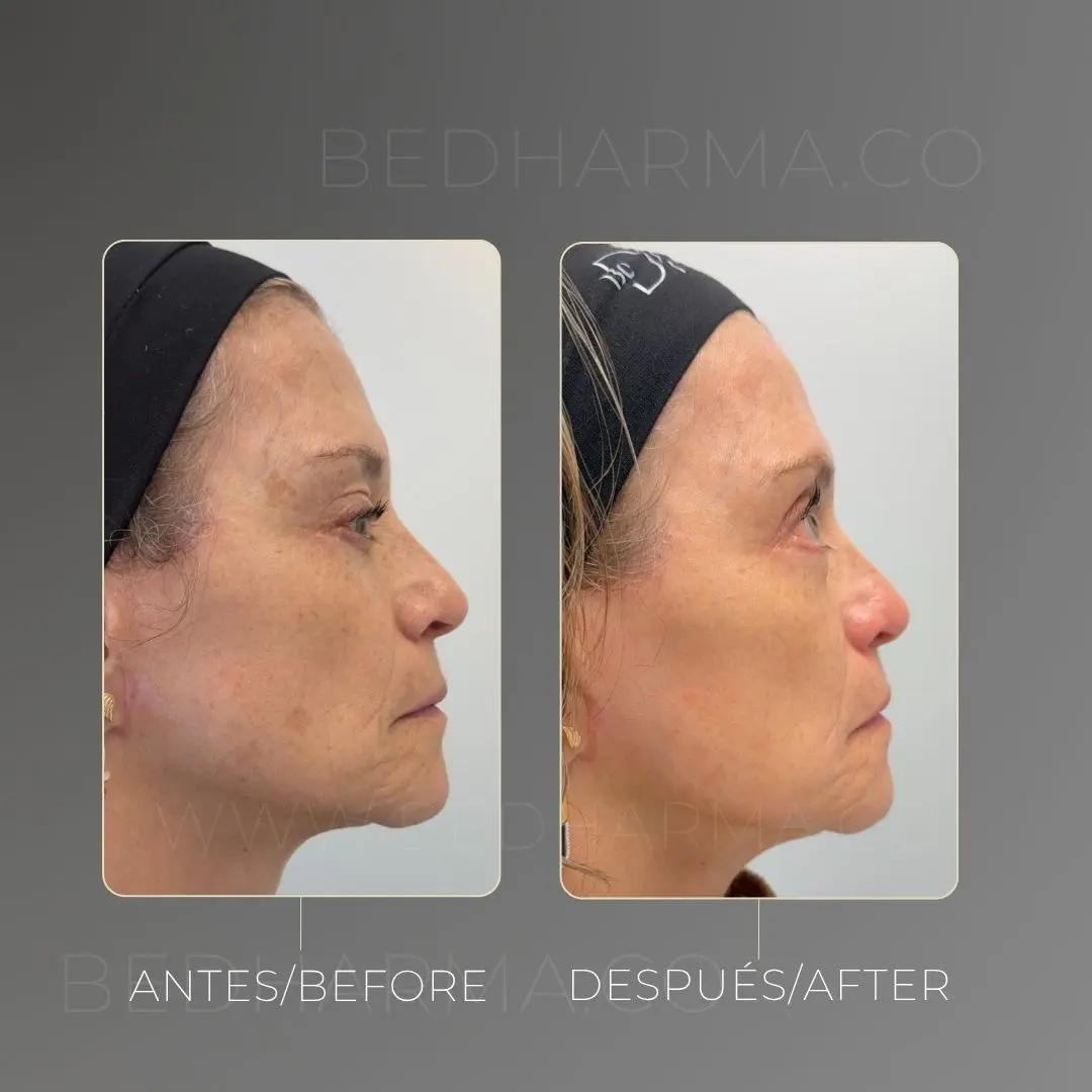 Despigmentación de melasma con láser colormax antes y después en Medellín - Clínica Estética Be Dharma 020826