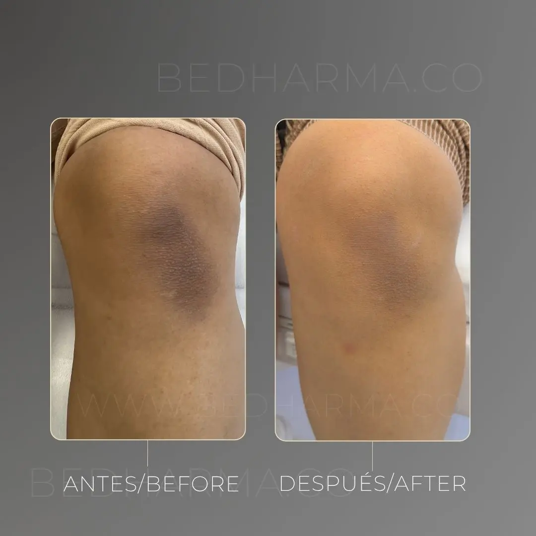 Despigmentación de rodilla con láser colormax antes y después en Medellín - Clínica Estética Be Dharma 020826