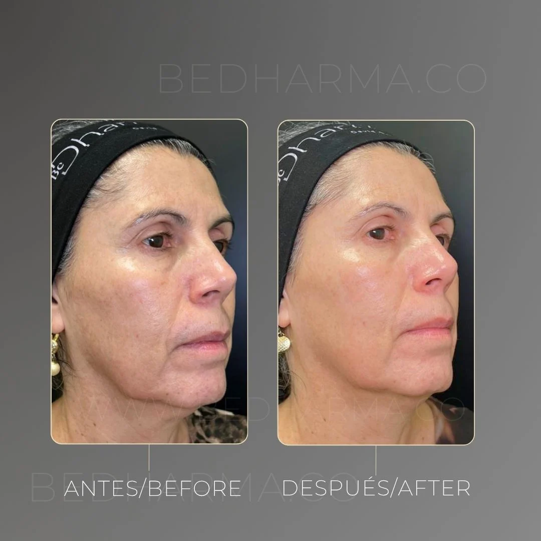 Despigmentación de manchas en la piel con Láser Colormax - Clínica Estética en Medellín Be Dharma