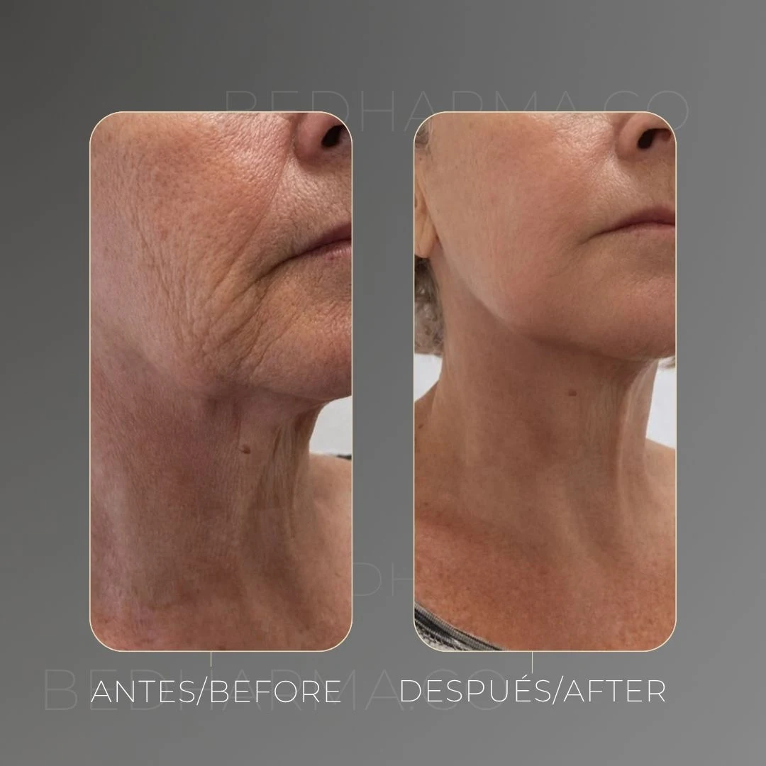 Lifting facial sin cirugía con Ultraformer MPT en Medellín - Clínica Estética Be Dharma en Torre Médica Oviedo