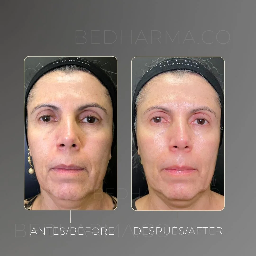 ColorMAX laser for dark spots at Clínica Be Dharma, Torre Médica Oviedo, Medellín