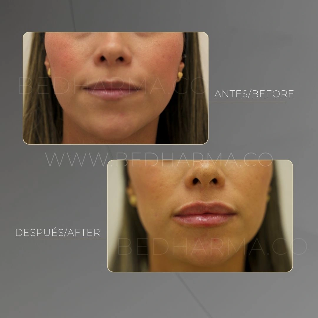 Lip harmonization with hyaluronic acid in Medellín at Clínica Be Dharma