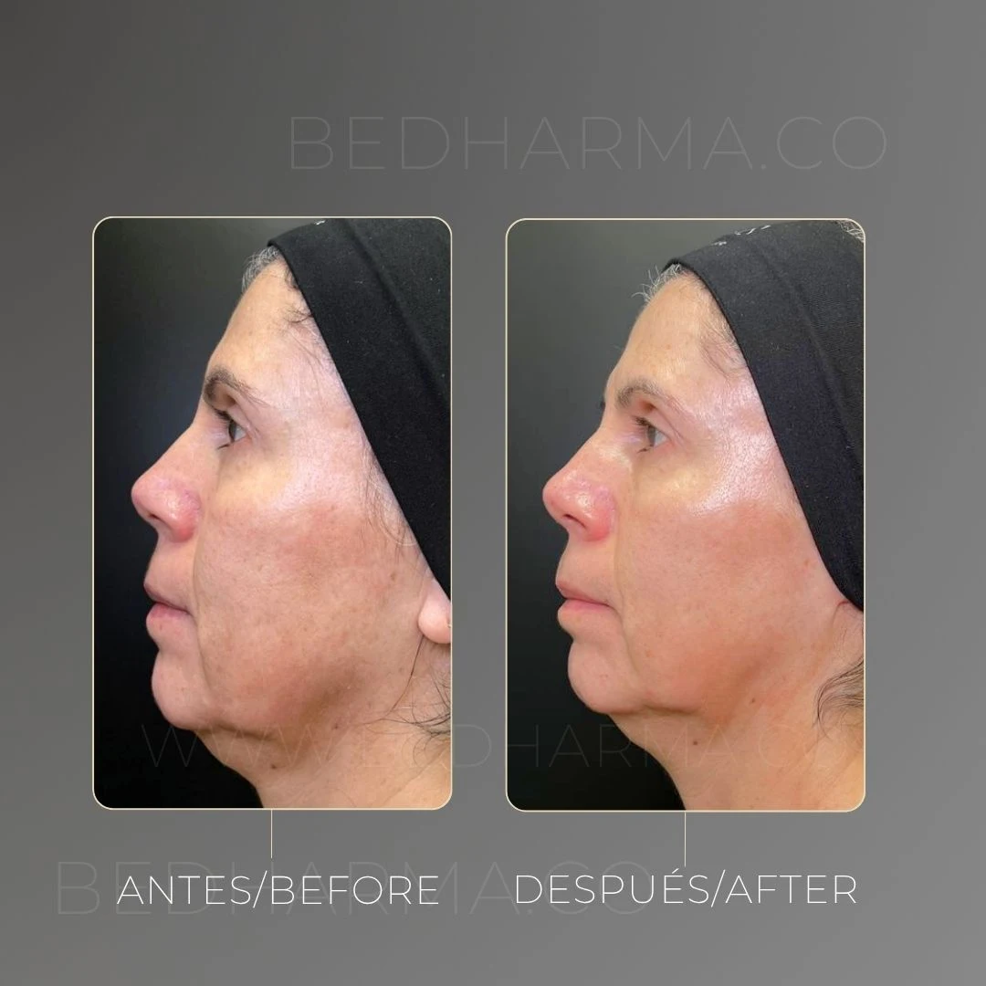 Removing skin pigmentation with ColorMAX laser in Medellín at Be Dharma