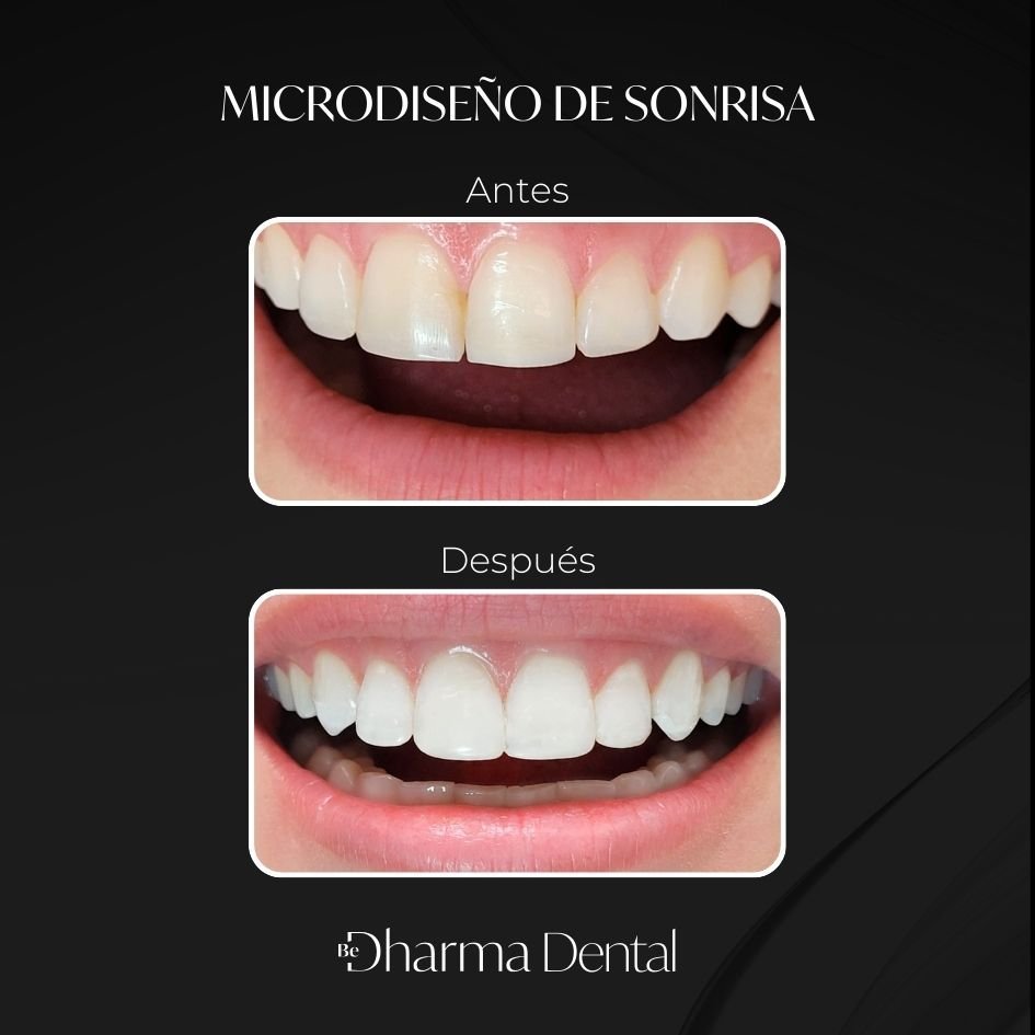 Antes y después de rehabilitación sobre implantes, Be Dharma Medellín