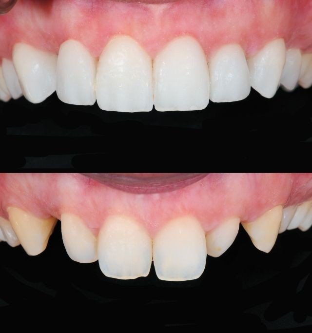 Resultado de implante y rehabilitación oral, Be Dharma Medellín