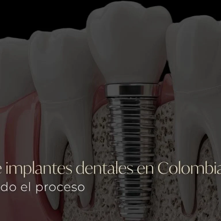Clínica de implantes dentales en Colombia Conoce todo el proceso - Be Dharma co - MEDELLIN